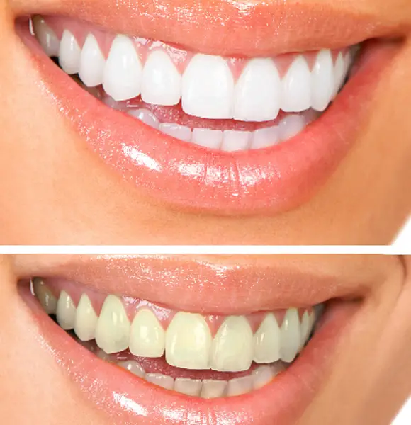 Here's How To Get White Teeth From 1 Day To A WeekBoth Fast And Naturally